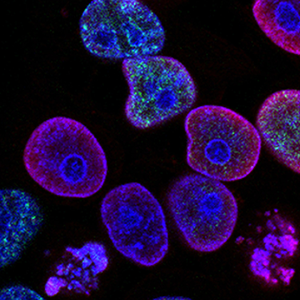 Colorectal cancer cells under a microscope; the cells are coloured purple, blue, and green against a dark background